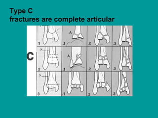 Type C
fractures are complete articular
 