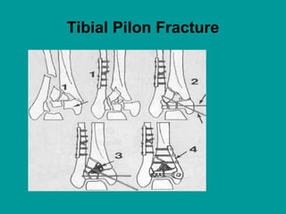 Tibial Pilon Fracture
 