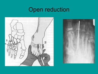 Open reduction
 