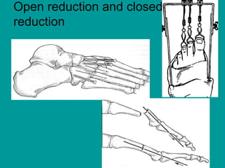 Open reduction and closed
reduction
 
