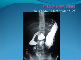 Bari Injection Role of radiology in surgery | PPT