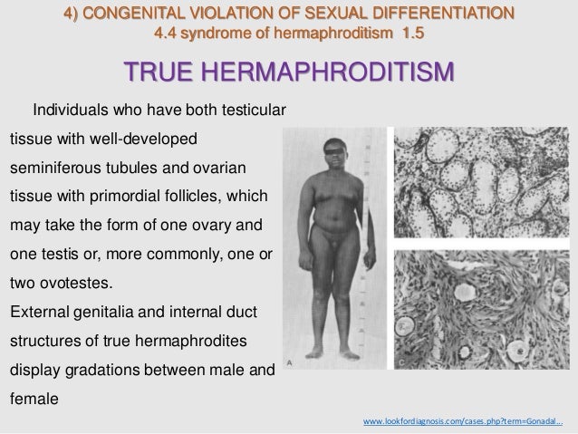 Hermaphrodite In Humans