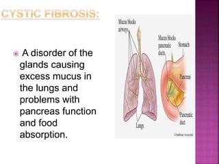  A disorder of the
glands causing
excess mucus in
the lungs and
problems with
pancreas function
and food
absorption.
 