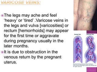 The legs may ache and feel
‘heavy’ or ‘tired’ .Varicose veins in
the legs and vulva [varicosities] or
rectum [hemorrhoids] may appear
for the first time or aggravate
during pregnancy usually in the
later months.
It is due to obstruction in the
venous return by the pregnant
uterus.
 