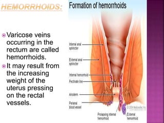 Varicose veins
occurring in the
rectum are called
hemorrhoids.
It may result from
the increasing
weight of the
uterus pressing
on the rectal
vessels.
 