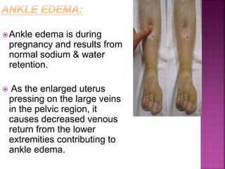 Ankle edema is during
pregnancy and results from
normal sodium & water
retention.
 As the enlarged uterus
pressing on the large veins
in the pelvic region, it
causes decreased venous
return from the lower
extremities contributing to
ankle edema.
 