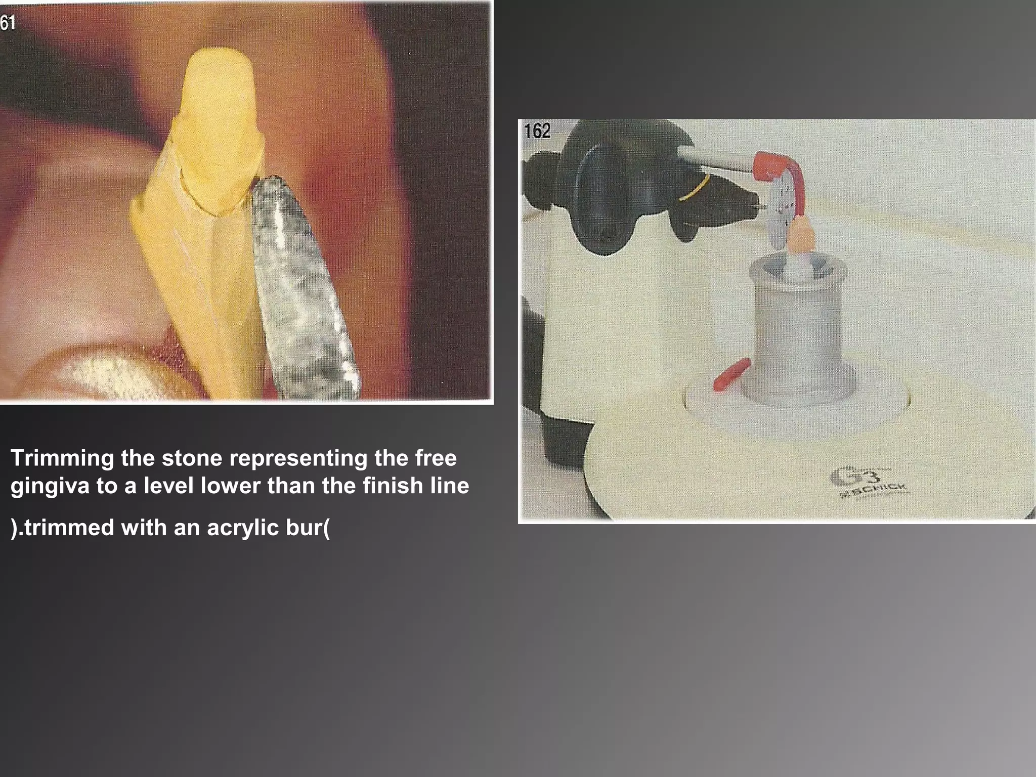 Trimming the stone representing the free
gingiva to a level lower than the finish line
(trimmed with an acrylic bur).
 