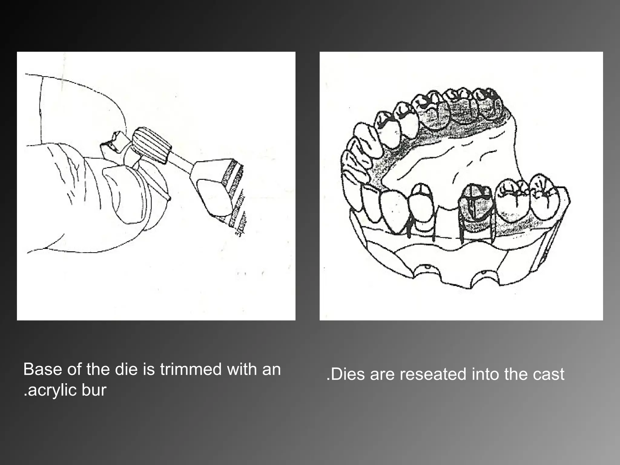 Base of the die is trimmed with an
acrylic bur.
Dies are reseated into the cast.
 