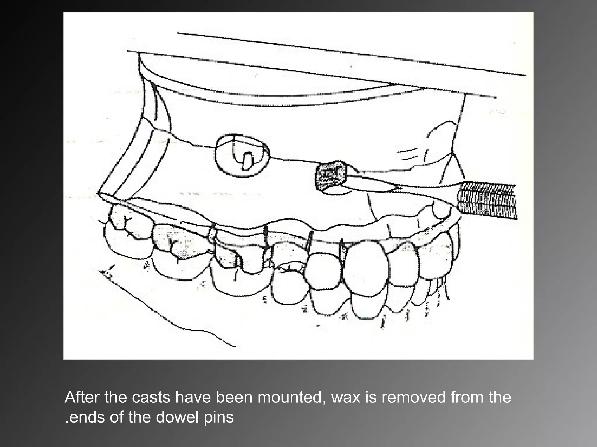 After the casts have been mounted, wax is removed from the
ends of the dowel pins.
 