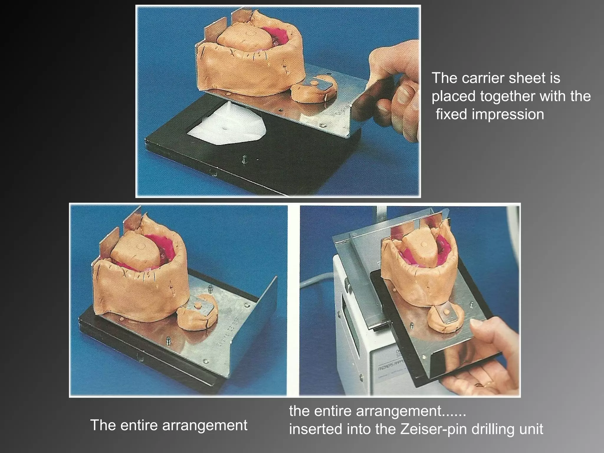 The carrier sheet is
placed together with the
fixed impression
The entire arrangement
......the entire arrangement
inserted into the Zeiser-pin drilling unit
 