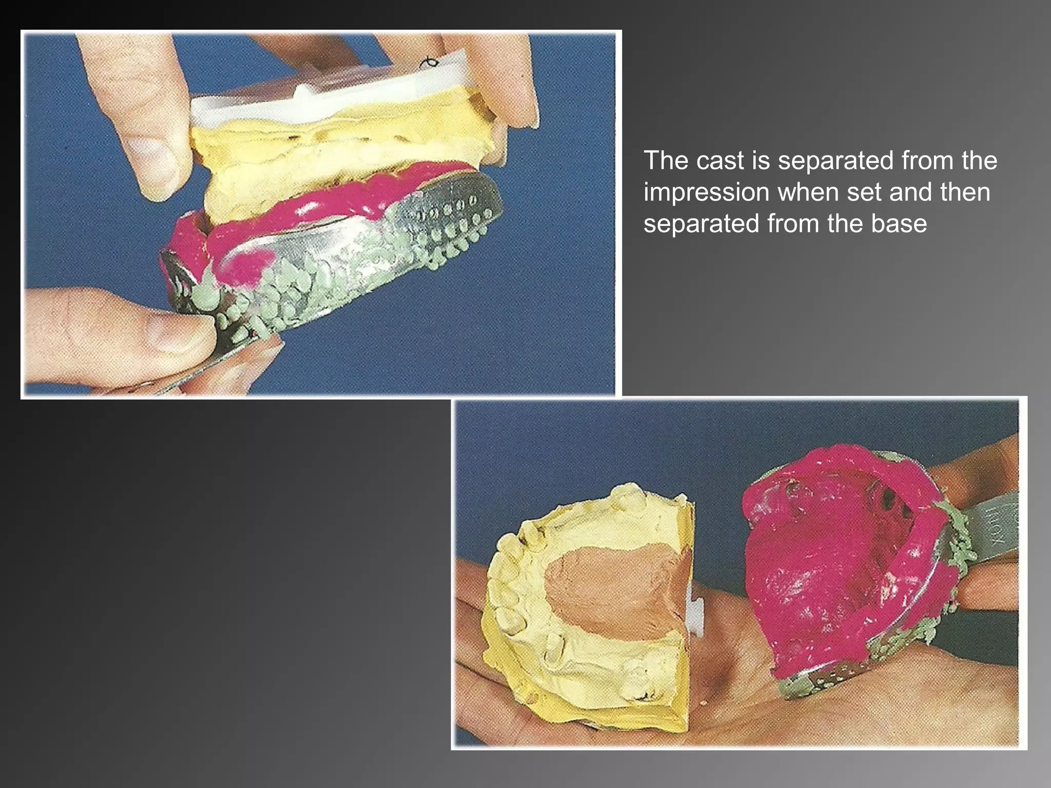 The cast is separated from the
impression when set and then
separated from the base
 