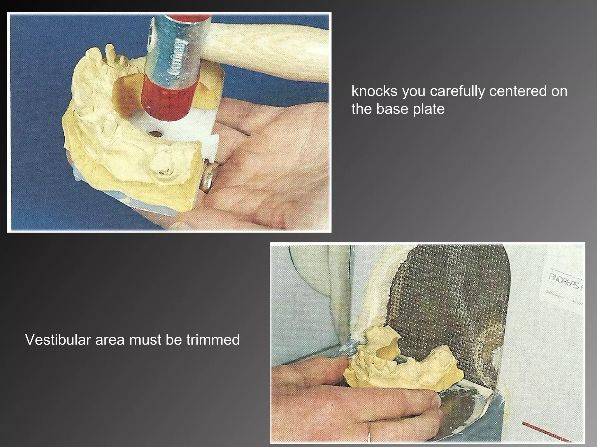 knocks you carefully centered on
the base plate
Vestibular area must be trimmed
 