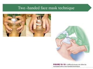 Airway management | PPTX