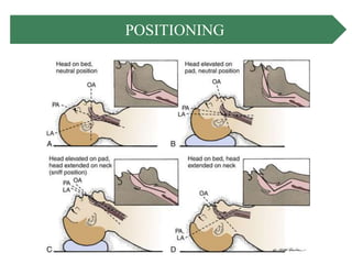 Airway management | PPTX