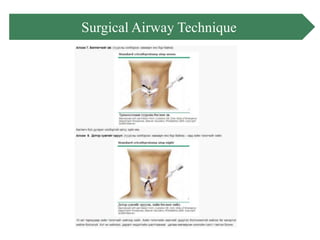 Surgical Airnet Airway management | PPTX