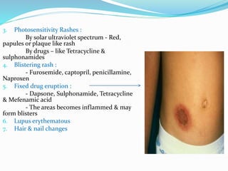 3. Photosensitivity Rashes :
By solar ultraviolet spectrum - Red,
papules or plaque like rash
By drugs – like Tetracycline &
sulphonamides
4. Blistering rash :
- Furosemide, captopril, penicillamine,
Naproxen
5. Fixed drug eruption :
- Dapsone, Sulphonamide, Tetracycline
& Mefenamic acid
- The areas becomes inflammed & may
form blisters
6. Lupus erythematous
7. Hair & nail changes
 