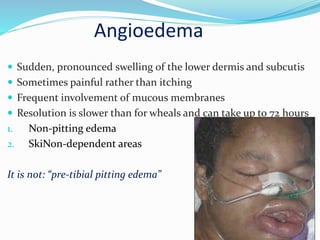 Angioedema
 Sudden, pronounced swelling of the lower dermis and subcutis
 Sometimes painful rather than itching
 Frequent involvement of mucous membranes
 Resolution is slower than for wheals and can take up to 72 hours
1. Non-pitting edema
2. SkiNon-dependent areas
It is not: “pre-tibial pitting edema”
 