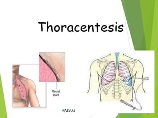 1
Thoracentesis
 