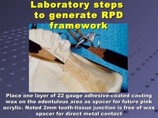 Beading Rpd 6. final impression techniques for removable partial dentures | PPT