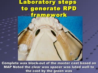 Wax Pattern Rpd 6. final impression techniques for removable partial dentures | PPT