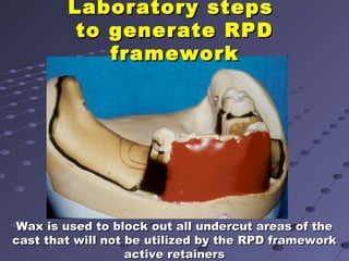 6. final impression techniques for removable partial dentures | PPT