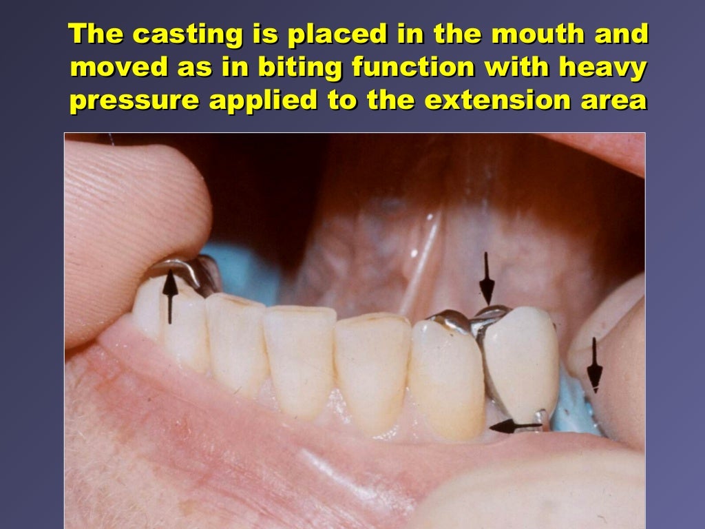 6. final impression techniques for removable partial dentures