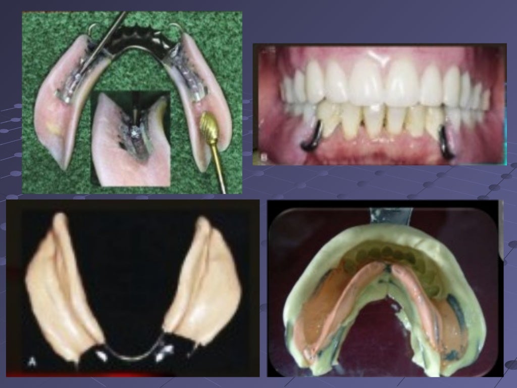 6. final impression techniques for removable partial dentures
