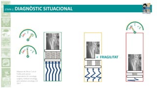 Adaptat de Ethun C et al:
Frailty and cancer:
Implications for oncology
surgery, medical oncology,
and radiation oncology. CA.
2017.
ETAPA 1: DIAGNÒSTIC SITUACIONAL
= FRAGILITAT
 