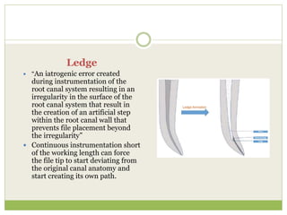Ledge
 “An iatrogenic error created
during instrumentation of the
root canal system resulting in an
irregularity in the surface of the
root canal system that result in
the creation of an artificial step
within the root canal wall that
prevents file placement beyond
the irregularity”
 Continuous instrumentation short
of the working length can force
the file tip to start deviating from
the original canal anatomy and
start creating its own path.
 