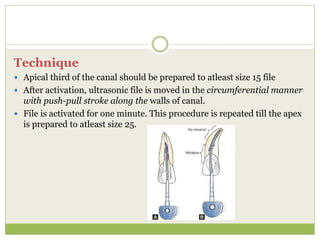 Technique
 Apical third of the canal should be prepared to atleast size 15 file
 After activation, ultrasonic file is moved in the circumferential manner
with push-pull stroke along the walls of canal.
 File is activated for one minute. This procedure is repeated till the apex
is prepared to atleast size 25.
 