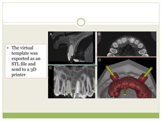  The virtual
template was
exported as an
STL file and
send to a 3D
printer
 