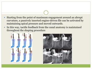  Starting from the point of maximum engagement around an abrupt
curvature, a passively inserted engine-driven file can be activated by
maintaining apical pressure and moved outwards.
 In this way, tactile feedback from the canal anatomy is maintained
throughout the shaping procedure
 