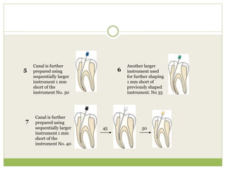 Canal is further
prepared using
sequentially larger
instrument 1 mm
short of the
instrument No. 30
5
Another larger
instrument used
for further shaping
1 mm short of
previously shaped
instrument. No 35
6
Canal is further
prepared using
sequentially larger
instrument 1 mm
short of the
instrument No. 40
7
45 50
 