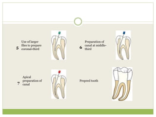 Use of larger
files to prepare
coronal-third5
Preparation of
canal at middle-
third6
Apical
preparation of
canal7
Prepred tooth
 