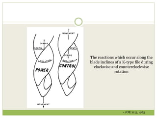 The reactions which occur along the
blade inclines of a K-type file during
clockwise and counterclockwise
rotation
- JOE:11:5, 1985
 