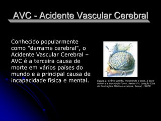 AVC - Acidente Vascular Cerebral

Conhecido popularmente
como "derrame cerebral", o
Acidente Vascular Cerebral –
AVC é a terceira causa de
morte em vários países do
mundo e a principal causa de
incapacidade física e mental.   Figura 1: Crânio aberto, mostrando o osso, a dura-
                                máter e a aracnóide.Fonte. Netter FH. coleção Ciba
                                de Ilustrações Médicas,arcelona, Salvat, 1987B
 