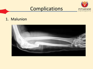 Complications
1. Malunion
 