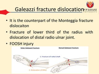 Galeazzi fracture dislocation
• It is the counterpart of the Monteggia fracture
dislocaiton
• Fracture of lower third of the radius with
dislocation of distal radio ulnar joint.
• FOOSH injury
 