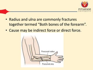 • Radius and ulna are commonly fractures
together termed “Both bones of the forearm”.
• Cause may be indirect force or direct force.
 