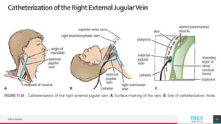 TREYresearch
CatheterizationoftheRightExternalJugularVein
Add a footer 10
 