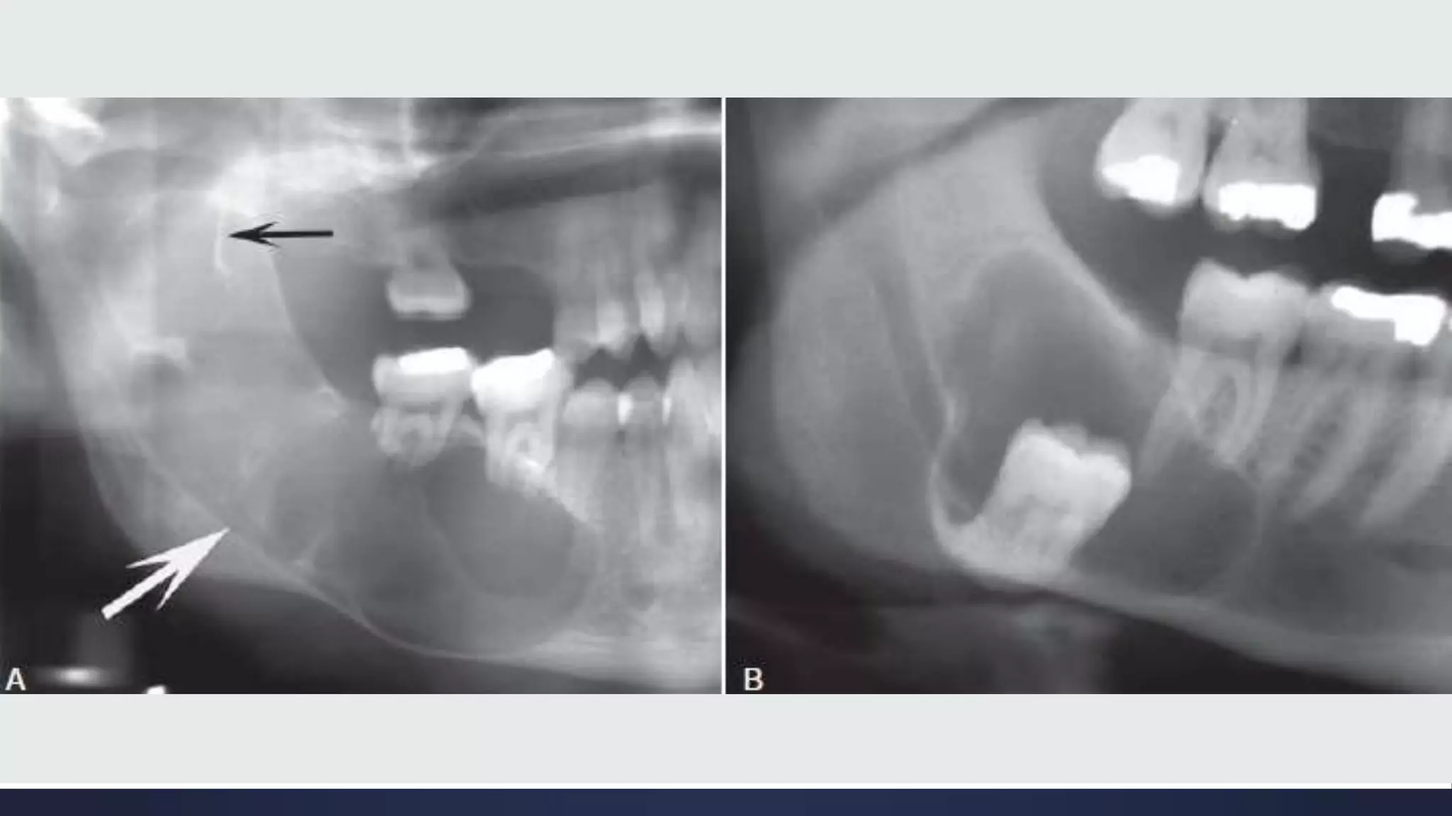 Radiographic Interpretation of Cyst and Cyst-like Lesions of the Jaws ...