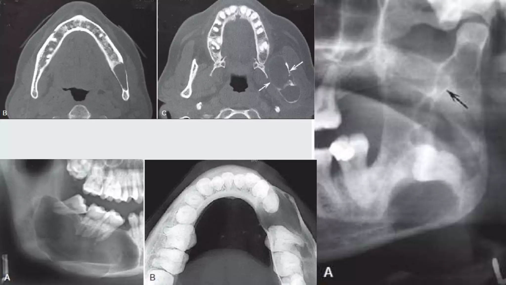 Radiographic Interpretation of Cyst and Cyst-like Lesions of the Jaws ...