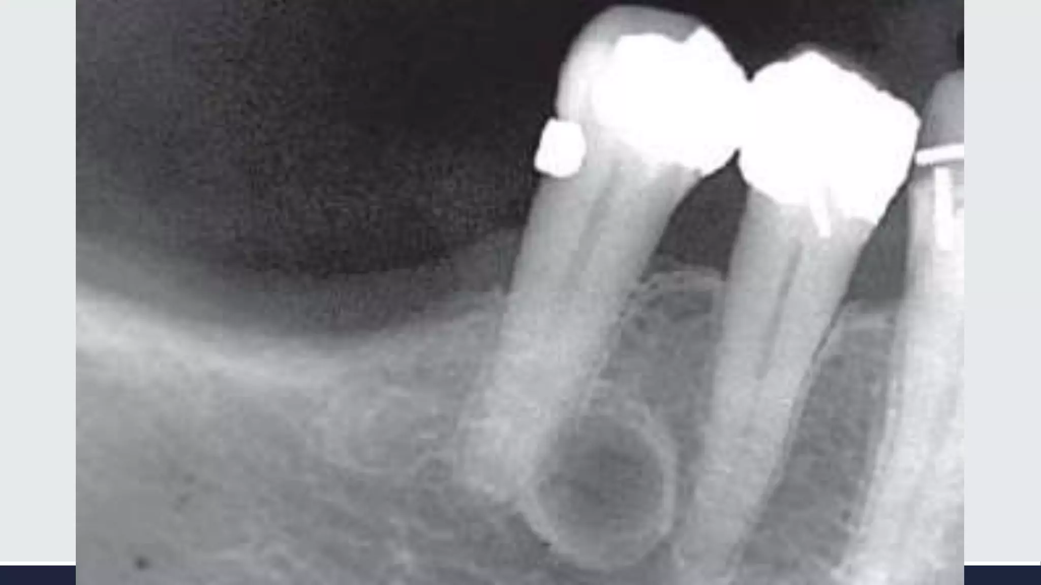 Radiographic Interpretation of Cyst and Cyst-like Lesions of the Jaws ...