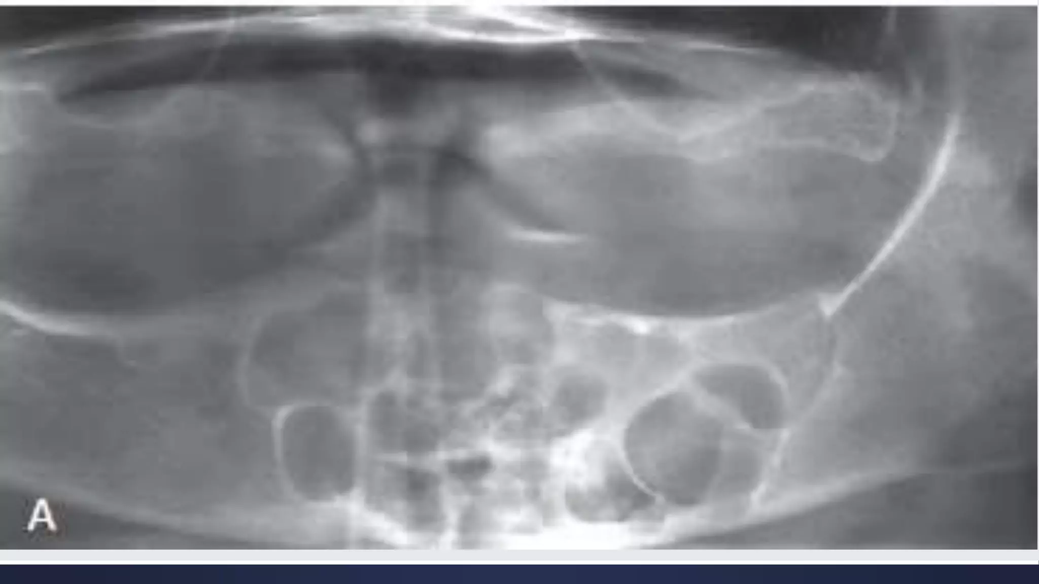 Radiographic Interpretation of Cyst and Cyst-like Lesions of the Jaws ...