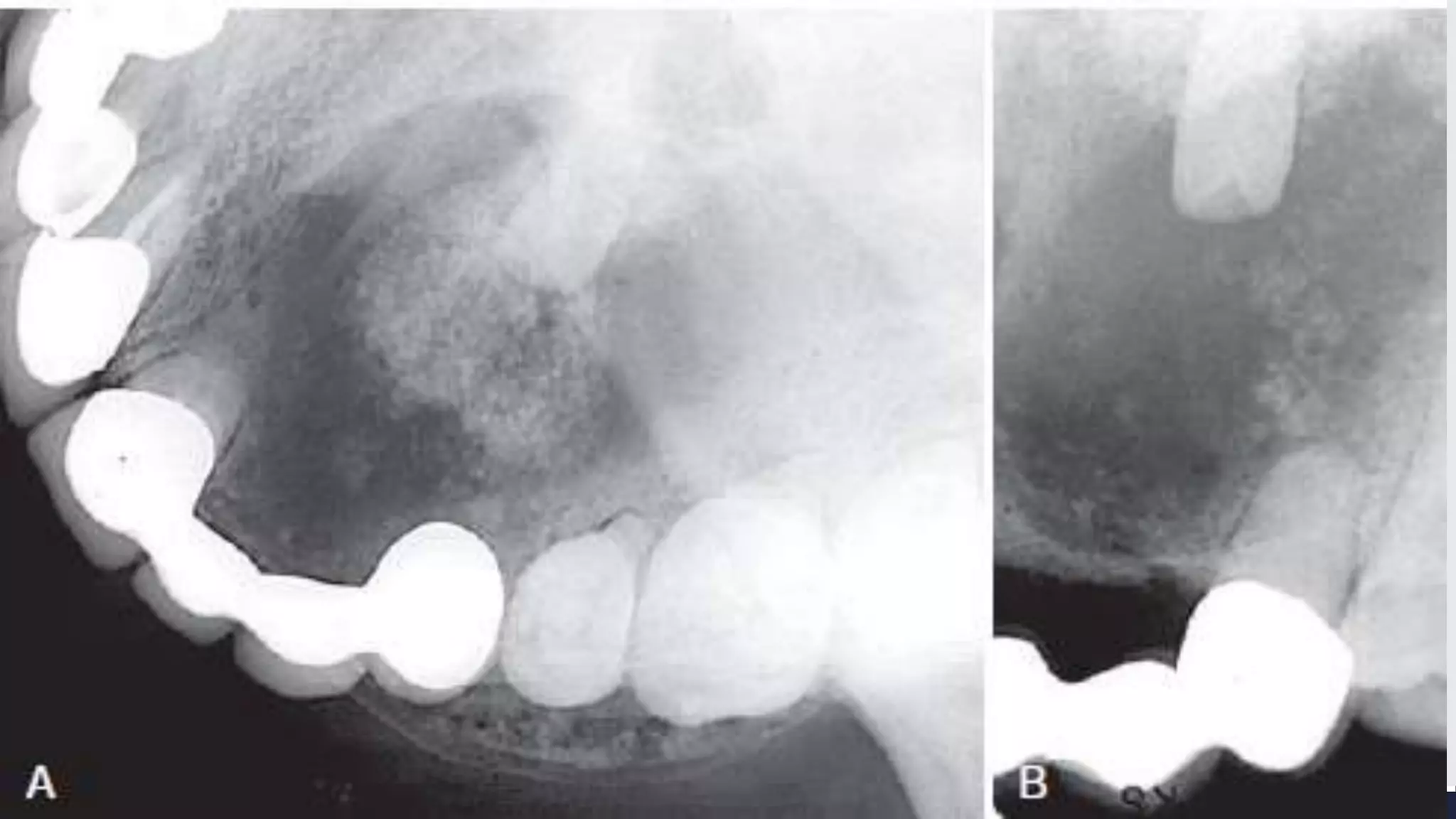 Radiographic Interpretation of Cyst and Cyst-like Lesions of the Jaws ...