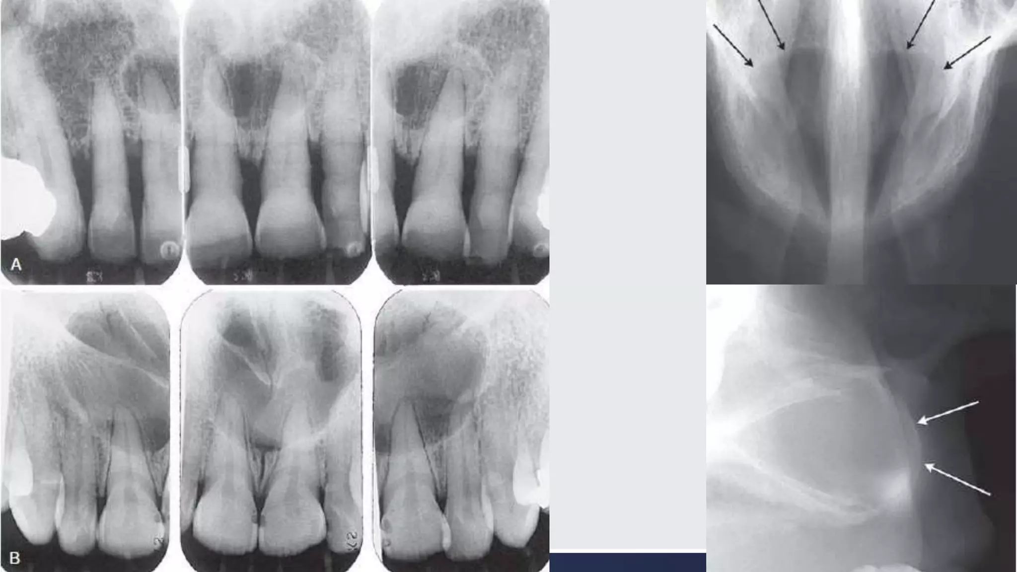 Radiographic Interpretation of Cyst and Cyst-like Lesions of the Jaws ...