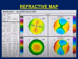 REFRACTIVE MAP
 