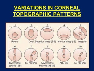 VARIATIONS IN CORNEAL
TOPOGRAPHIC PATTERNS
 