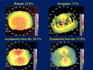 Round: 22.6%
Symmetric bow-tie: 17.5%Asymmetric bow-tie: 32.1%
Irregular: 7.1%
 