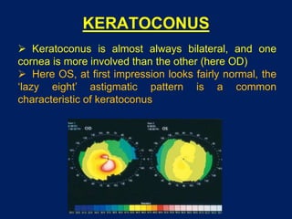 KERATOCONUS
 Keratoconus is almost always bilateral, and one
cornea is more involved than the other (here OD)
 Here OS, at first impression looks fairly normal, the
‘lazy eight’ astigmatic pattern is a common
characteristic of keratoconus
 